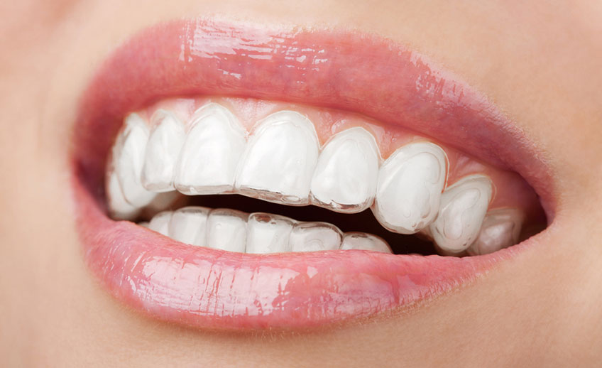 Invisalign - Smile Clínica Odontológica